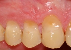 Surgical treatment of multiple gingival recessions with dura mater No. 19