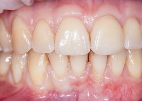 Surgical treatment of multiple gingival recessions with No. 5 transplant