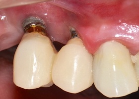 Surgical treatment of multiple gingival recessions with No. 4 transplant