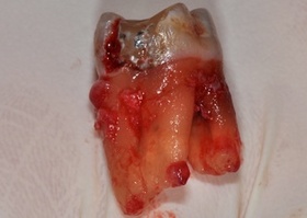 Thickening of the gum biotype with autotransplant №1