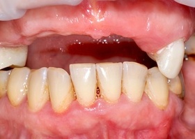 Removal of odontogenic cyst, plastic of alveolar Lioplast Mix-Max №1