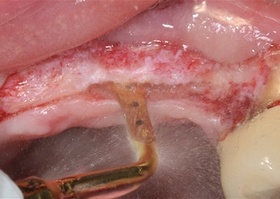 Removal of teeth and roots, alveolar plastics, NTR, together with implantation No. 5