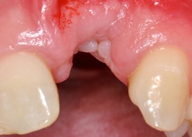 Cleavage of the alveolar NTR Lioplast Mix-Max c PDF
