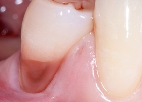 Gum plastics in the area of FDM with autograft No. 1