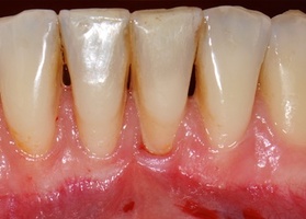 Surgical treatment of a single gum recession using single-layer technique No. 2