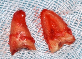 Removal of teeth and roots, alveolar plastics, NTR, together with implantation No. 5