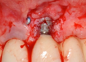 Periimplantitis treatment. Plastic defect Lioplast Mix-MAX with TMO (dura mater) No. 3