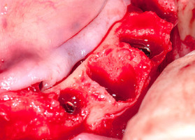 Early and delayed dental implantation after tooth extraction with allogenic osteoplastic materials