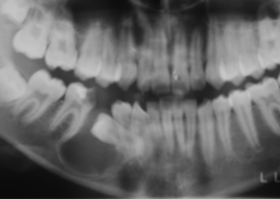 The effectiveness of the use of allogeneic demineralized spongiosa Lyoplast-S ® in pediatric and adult dentistry