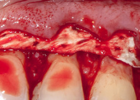 Efficiency of coronal displacement with membrane TMO Lyoplast-S ® for the treatment of multiple recessions