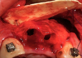 Evaluation of the effect of osteoplastic materials on bone tissue regeneration after cystectomy surgery with resection of the root apex