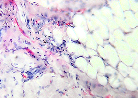 Clinical and experimental substantiation of a new method of surgical treatment of patients with retention of the lower third molars